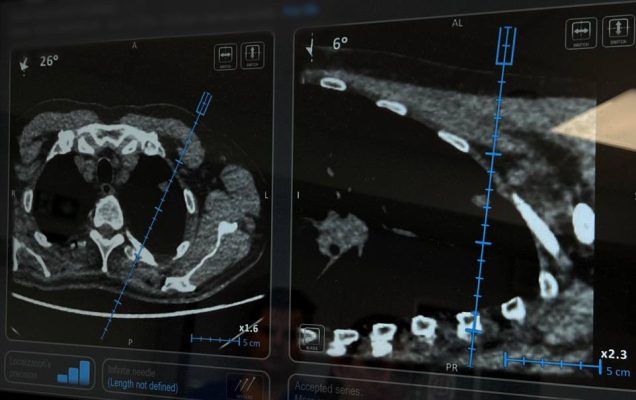 Obrazy tomografii komputerowej przedstawiające przekrój poprzeczny i strzałkowy tułowia, z niebieską linią wskazującą ścieżkę i kąt procedury wprowadzania igły. Pomiary i kąty są zaznaczone na skanach.