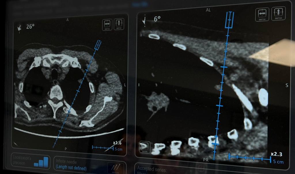 Obrazy tomografii komputerowej przedstawiające przekrój poprzeczny i strzałkowy tułowia, z niebieską linią wskazującą ścieżkę i kąt procedury wprowadzania igły. Pomiary i kąty są zaznaczone na skanach.