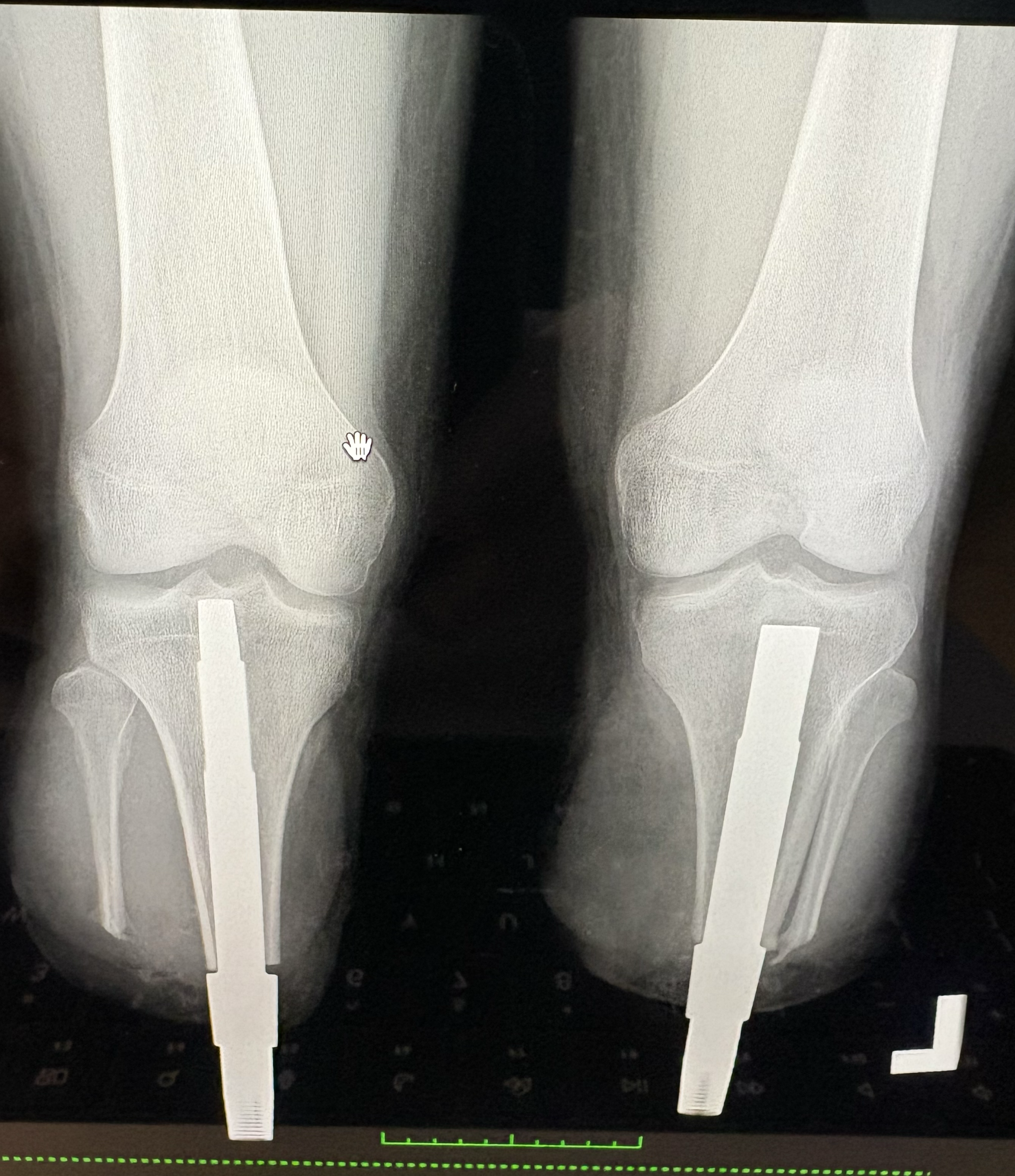 Zdjęcie RTG kończyn.