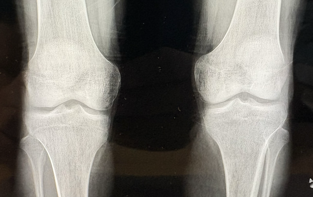 Zdjęcie RTG kończyn.
