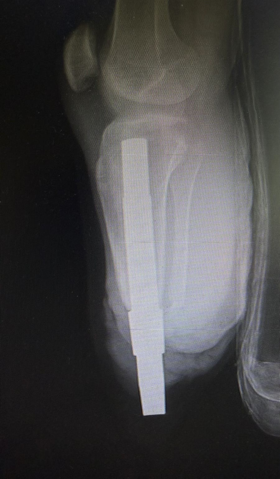 Zdjęcie RTG kończyny lewej.