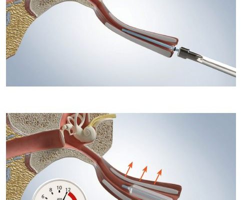 4 elementowa Infografika zabiegu balnoplastyki. Na pierwszym ujęciu widać model ludzkiej głowy z przyłożonym do nosa urządzeniem medycznym. Na 3 pozostałych grafikach zabieg balnoplastyki.
